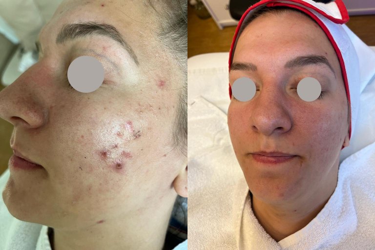 Microneedling (mikrojehličkování, Dermapen) - foto č. 1