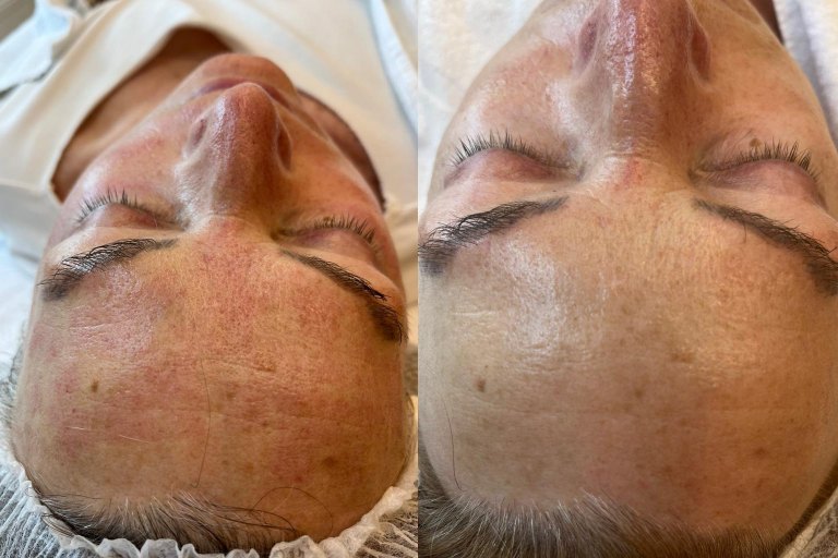 Microneedling (mikrojehličkování, Dermapen) - foto č. 2