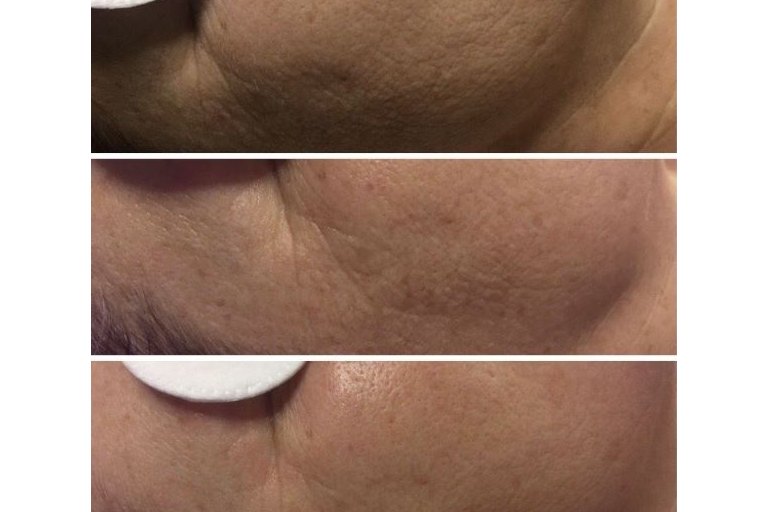 Microneedling (mikrojehličkování, Dermapen) - foto č. 3